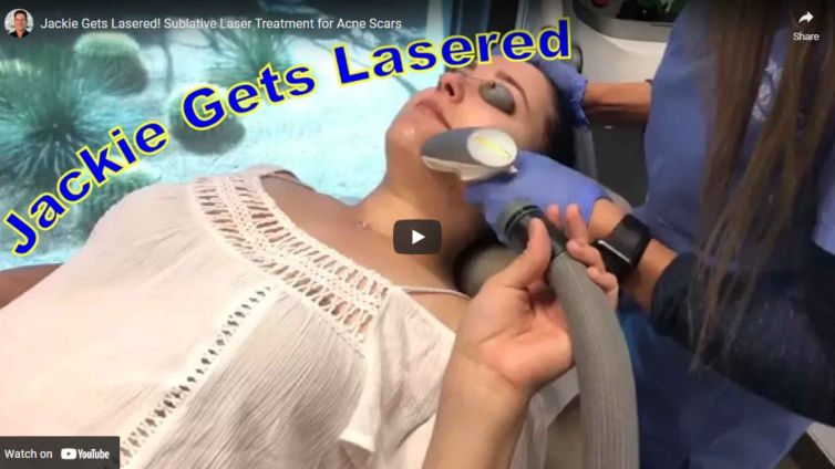 Jackie Gets a Sublative Treatment for Her Acne Scars