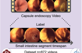 AI for Capsule Endoscopy: | gutsandgrowth