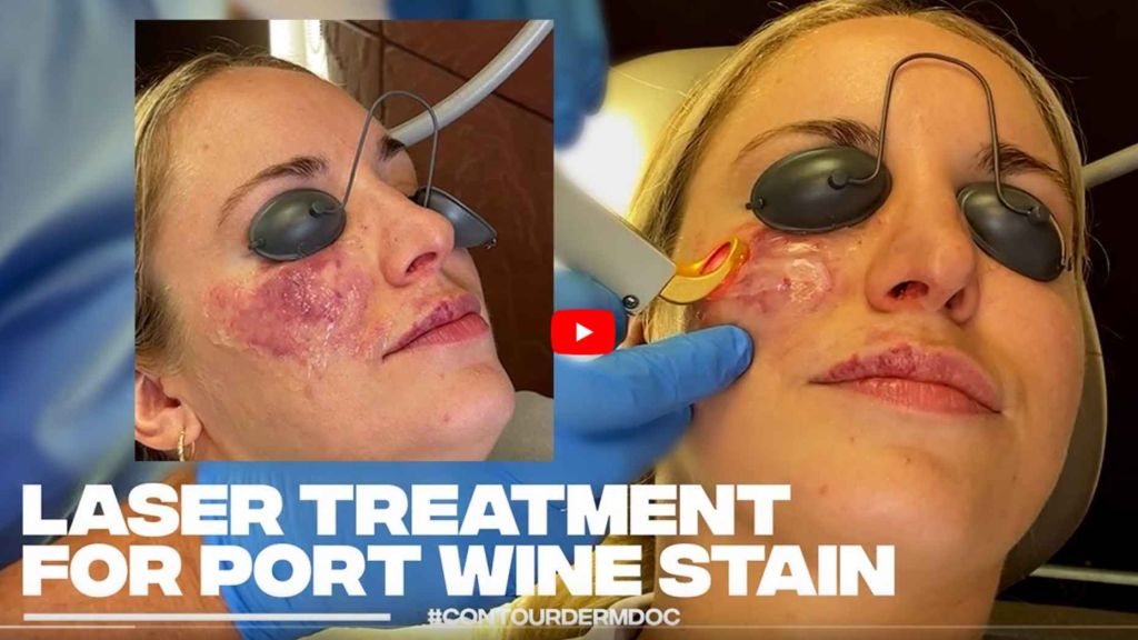 Board Certified Dermatologist Dr. Timothy Jochen treats a Port Wine Stain using the Excel V for today's #ContourDermDoc