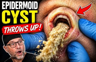 This Cyst Had a MOUTH… and Then It THREW UP 🤢