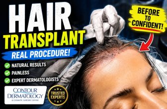 Woman’s Hairline Transplant: Real Dermatology Procedure Up Close!
