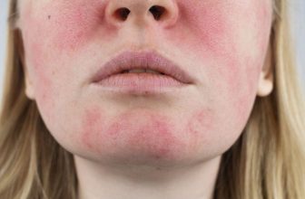 Why Your Face is Always Red