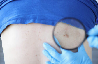 Understanding Squamous Cell Carcinoma Scars In St. Louis