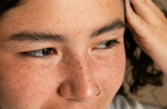 St. Louis Summer Melasma Prep Guide and Timeline