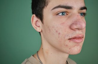 Acne Causes, Care, and Prevention