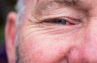 Rosacea Flare Tips for St. Louis Heat and Humidity