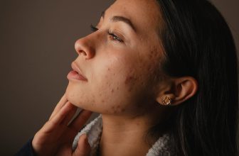 Expert Dermatologist Acne Care in St. Louis