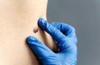 Mole Removal Facts for St. Louis Patients