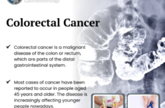 Colorectal Cancer 2024, Risks, & Treatments