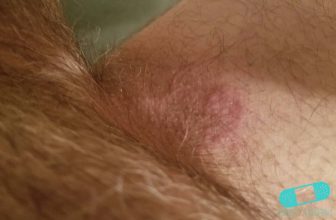 Intertrigo – Online Dermatology