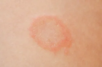 What Does Ringworm Look Like? Other Ringworm Answers