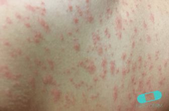 Spots and Rashes Caused by Viruses