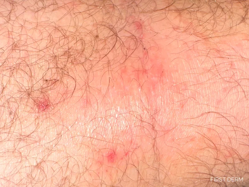 Learn about Atopic Dermatitis, a common cause of winter rash and dry skin. Discover symptoms like red, itchy patches and tips for soothing inflamed skin effectively.