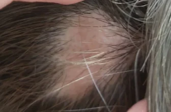 Understanding Alopecia Areata & Causes of Sudden Patchy Hair Loss