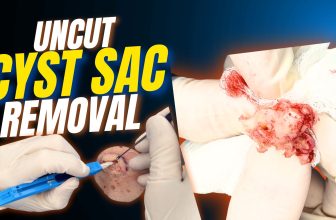 RAW & UNCUT: Massive Mushy Cyst Extraction