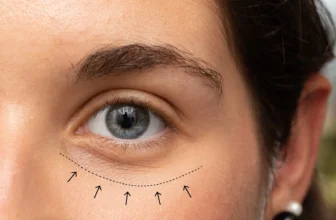 How Much Does A Blepharoplasty Cost?
