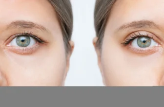 Blepharoplasty Recovery Timeline – What To Expect