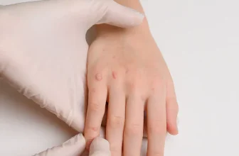 What They Look Like and How to Treat Them