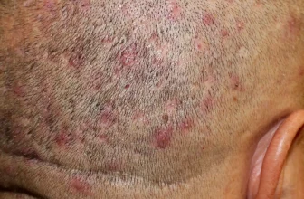 What Is Fungal Acne (Malassezia Folliculitis)