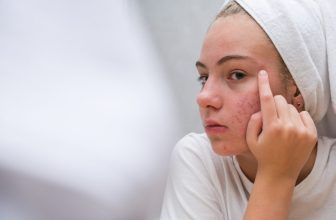 Skin Purging vs. Breakout: The Difference in Teens
