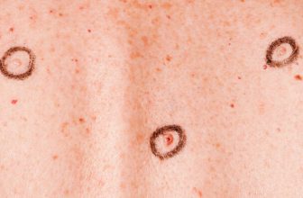 Amelanotic Melanoma: Symptoms, Causes & Treatment