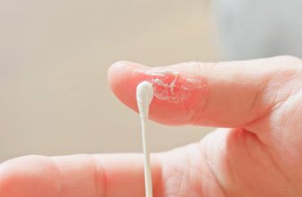 Dyshidrotic Eczema: Causes, Triggers, and Treatment