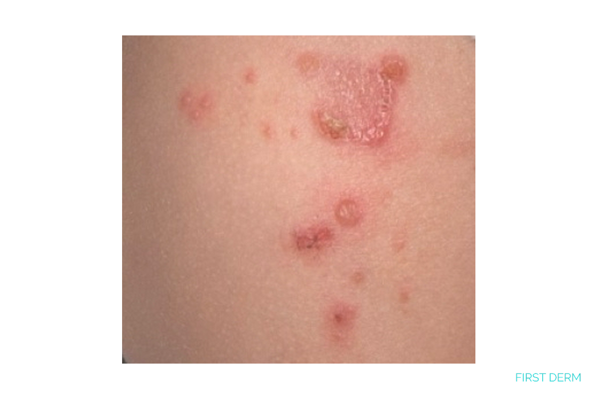 Close-up of impetigo rash showing red, crusted lesions and blisters caused by bacterial skin infection