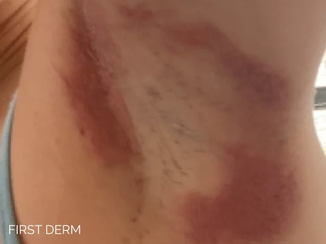 Intertrigo under the armpit showing red, inflamed skin with a burn-like appearance. Symptoms include irritation, itching, and discomfort, common in skin fold dermatitis