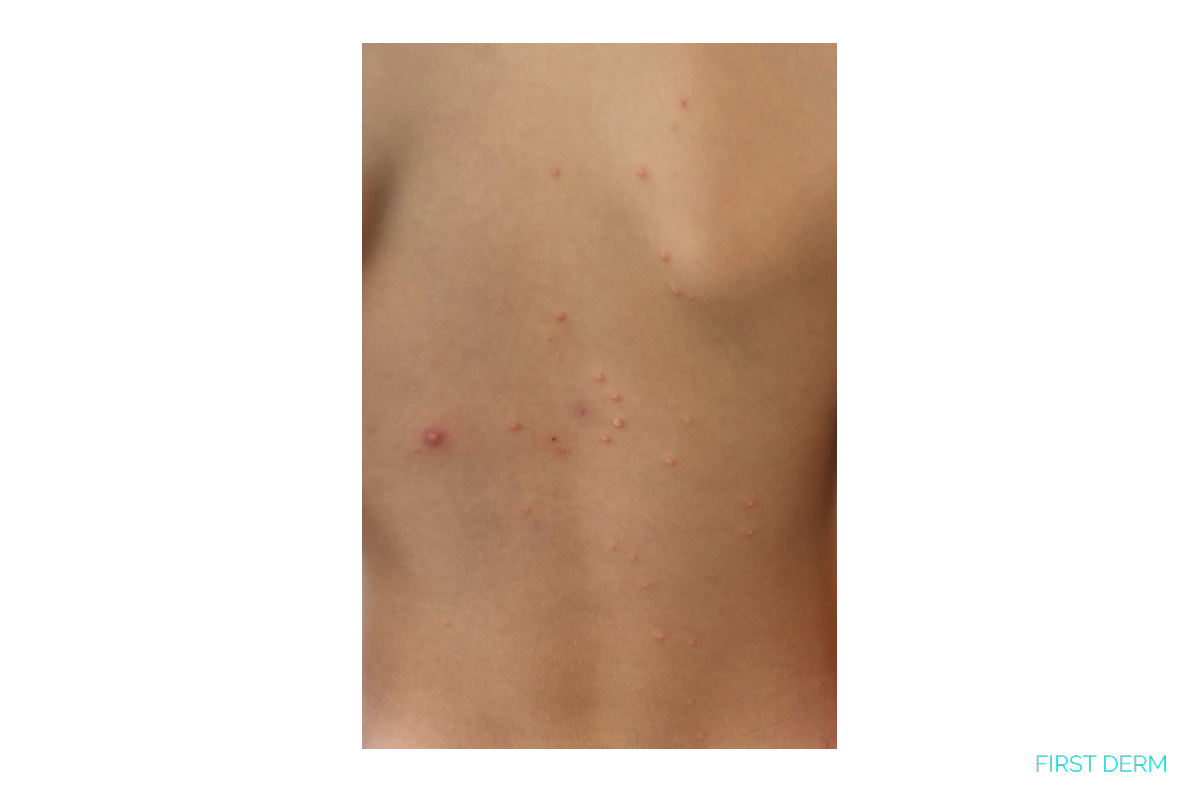 Multiple small raised molluscum contagiosum papules scattered across a child's torso, showing the typical spread pattern of this viral skin infection