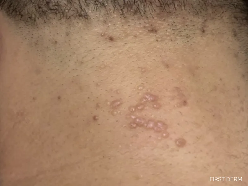 Rash caused by a virus, Molluscum Contagiosum, showing shiny papules with central indentations on the neck, a type of viral exanthem