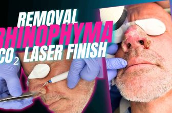 Rhinophyma Treatment –  Electrosurgical Removal + CO₂ Laser