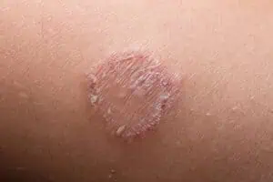 ringworm