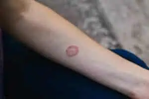 Ringworm rash on a woman’s arm