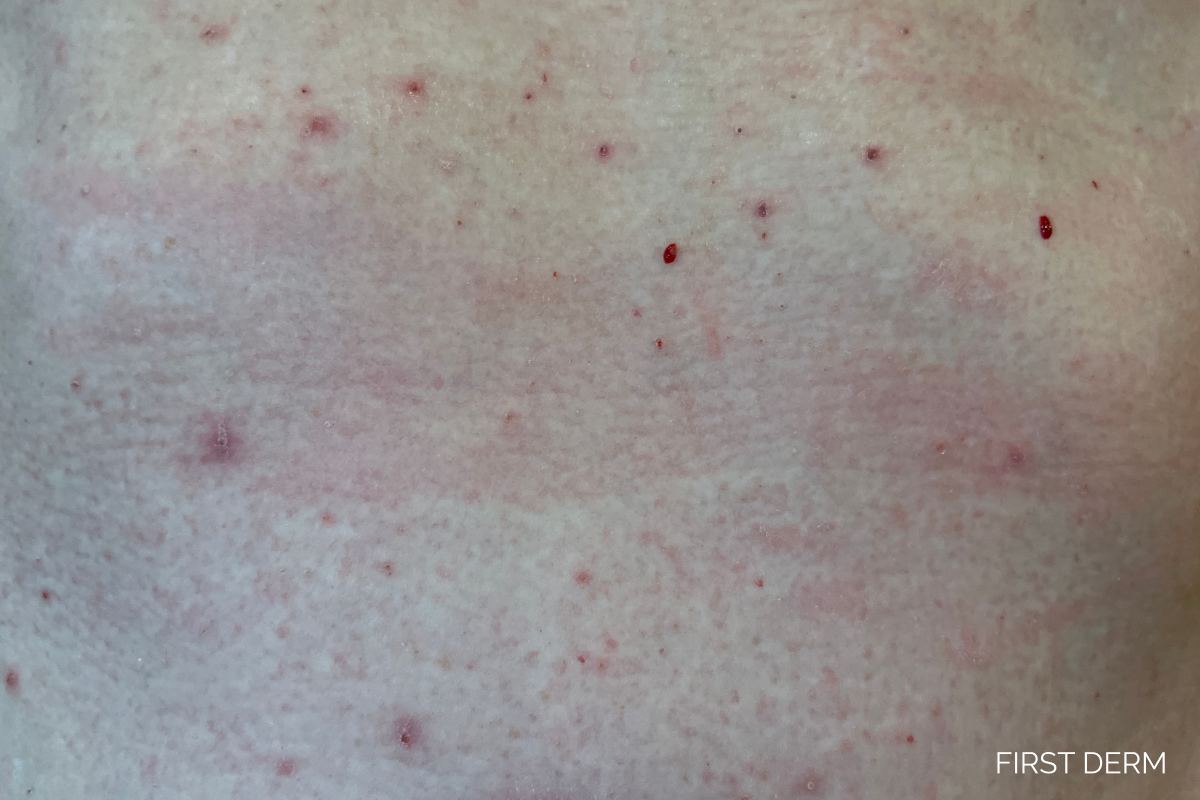 Multiple small red inflamed spots and papules scattered across the skin showing a typical scabies rash caused by the Sarcoptes scabiei mite