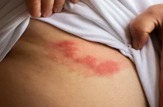 ‘What Is Shingles?’ and Other Shingles FAQs Answered