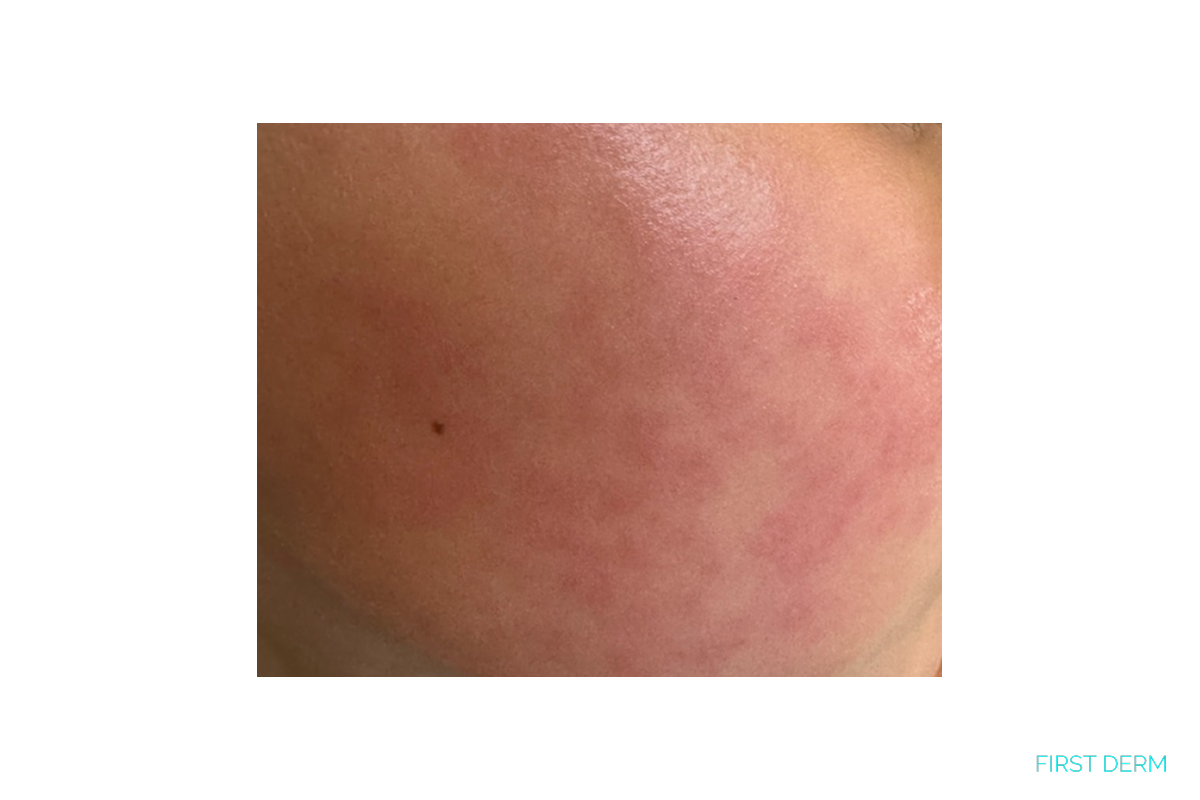 Bright red facial flushing on a child's cheek showing the characteristic slapped cheek appearance of erythema infectiosum caused by parvovirus B19