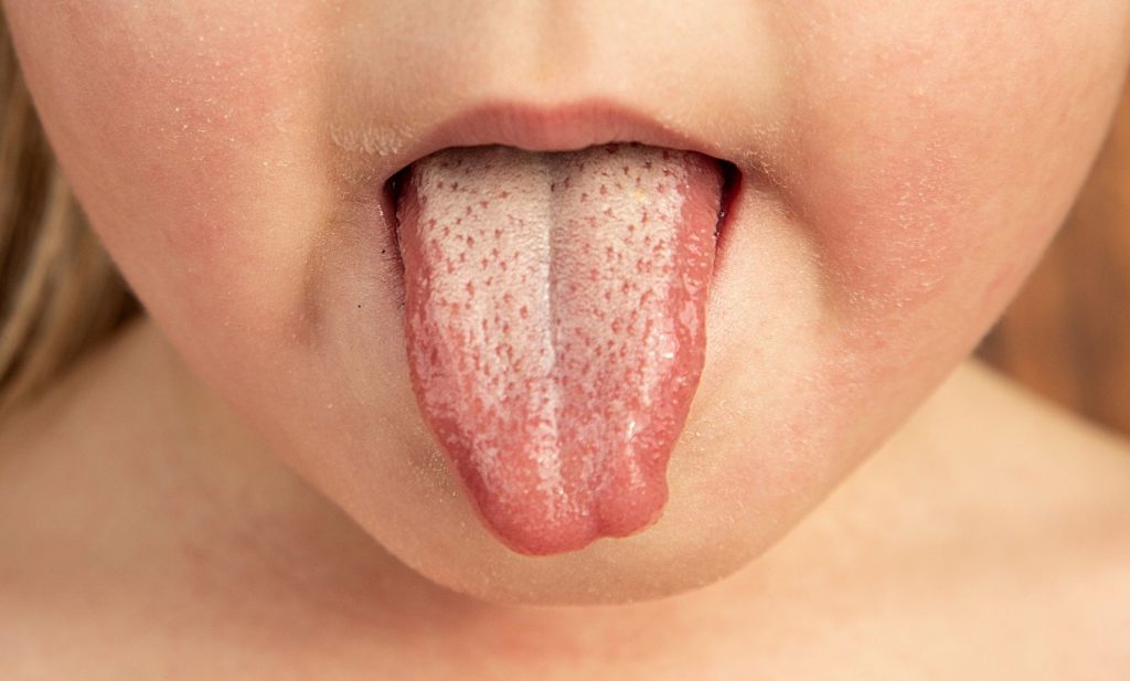 A child sticking out their tongue, which shows the white coating that is one of the symptoms of scarlet fever