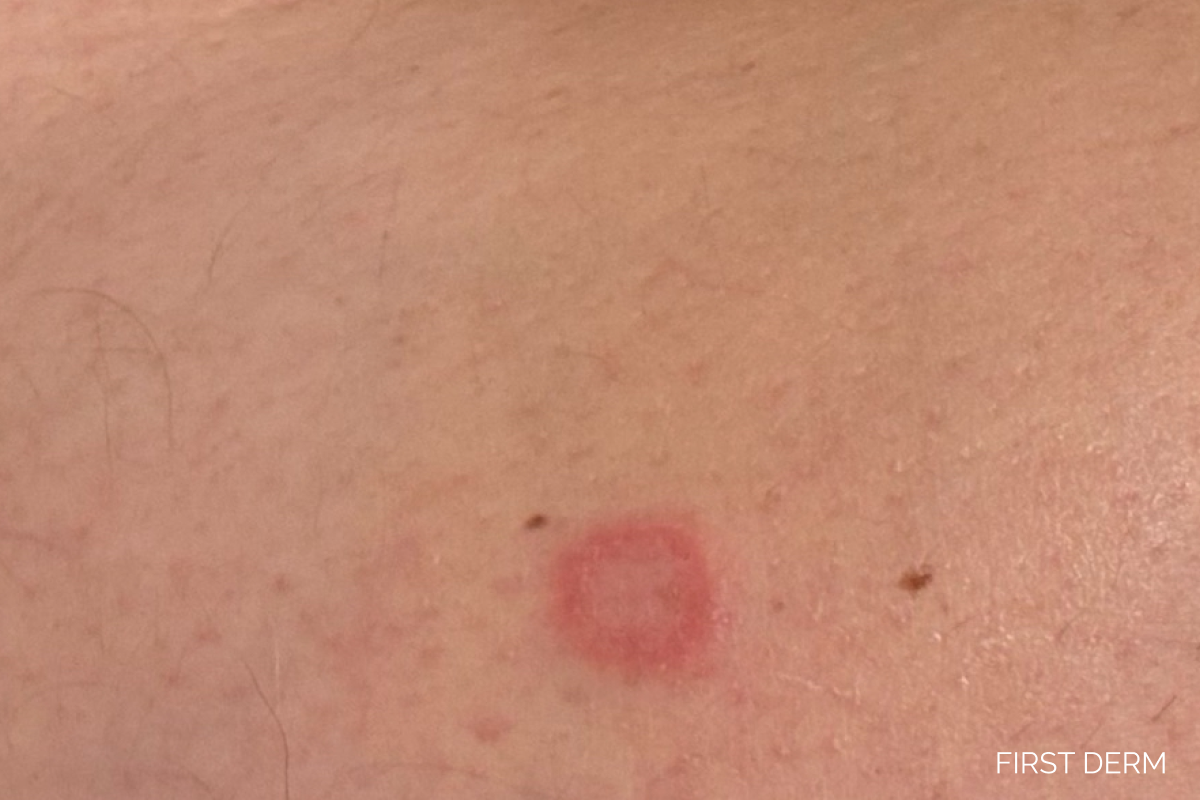 Close-up of tinea corporis showing a circular red scaly ringworm patch on the trunk with clearer skin at the centre