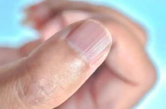 Ridges in Fingernails: Causes and Treatments