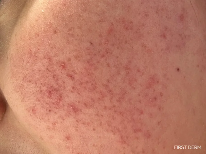 Winter rash with rosacea on cheek, characterized by red dots, dryness, and redness, triggered by cold weather, heat, and temperature changes
