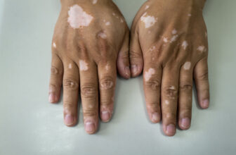 Pfizer Pill’s Phase 3 Data in Vitiligo Pave Way for FDA, EMA Submissions