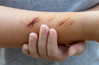 Top 11 Homeopathic Medicines For Treating Wounds and Injuries