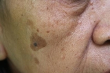 August Skincare Tips for Sun-Damaged Skin