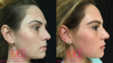 What Are the Best Lasers For Sunspots?