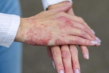 Triggers, Symptoms, and Treatment Options