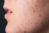 What to Know About Acne Treatment Options