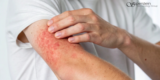 Allergic Rashes: Finding the Cause, Not Just Treating the Symptoms