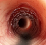 The Rise of Eosinophilic Esophagitis