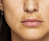Lighten Up Your Upper Lip – Treatment Options