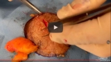 Lobster Lipoma (Easy Lipoma Removal)